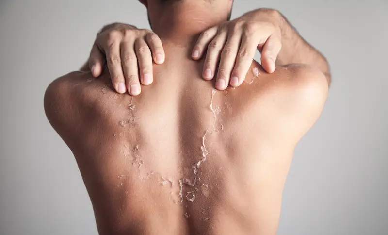 Man with a sunburn on his back that is peeling.